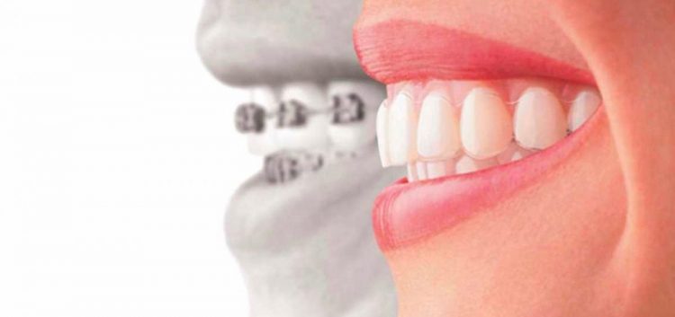 invisalign-saude-brasilia-aparelho-transparente