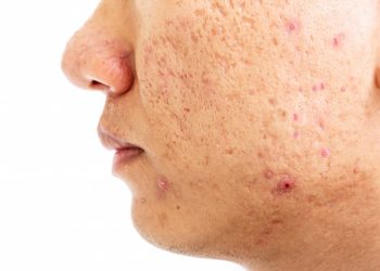 cicatriz-acne-cicatrizes-saude-brasilia-dermatologista