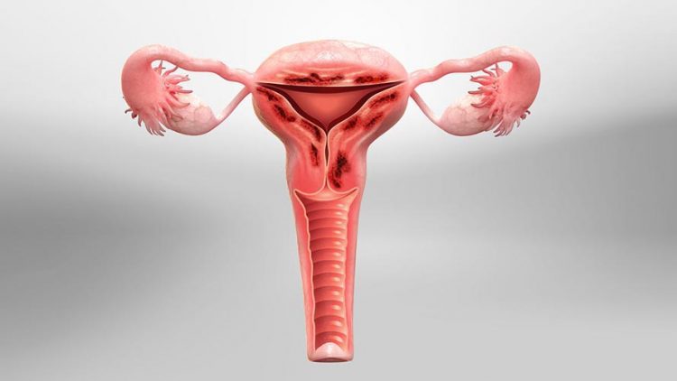 adenomiose-utero-endomerio-saude-brasilia