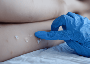 Ministério da Saúde cria Sala de Situação para monitorar casos a varíola dos macacos no Brasil