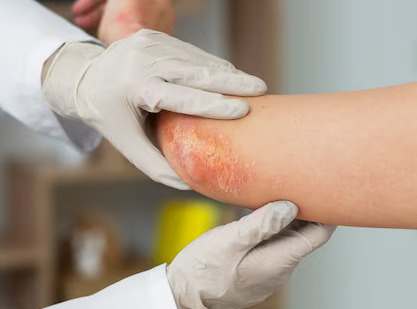Pesquisadores desenvolvem tratamento natural contra a psoríase